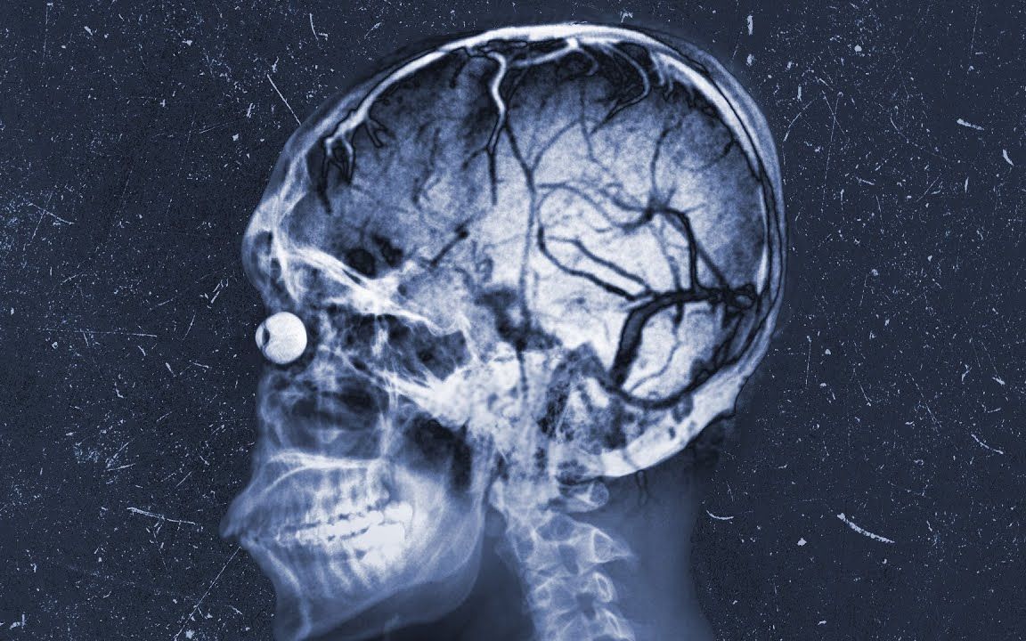 一位比特币矿工在睡觉时中暑了，他的器官是这样衰竭的